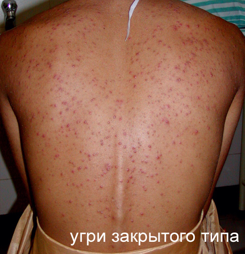 Угри закрытого типа