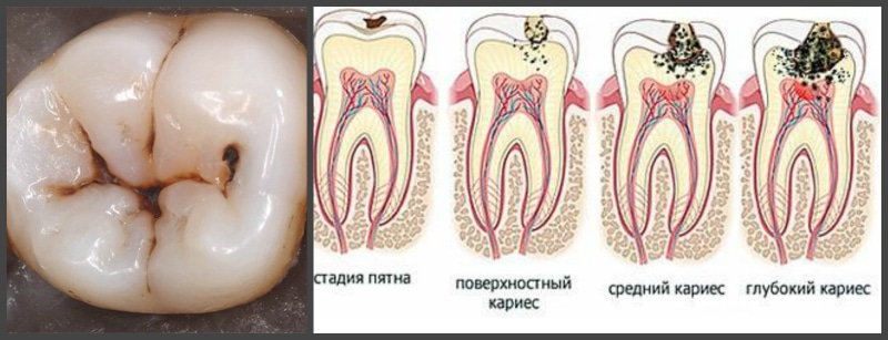 Стадии кариеса. Стадии кариеса.
